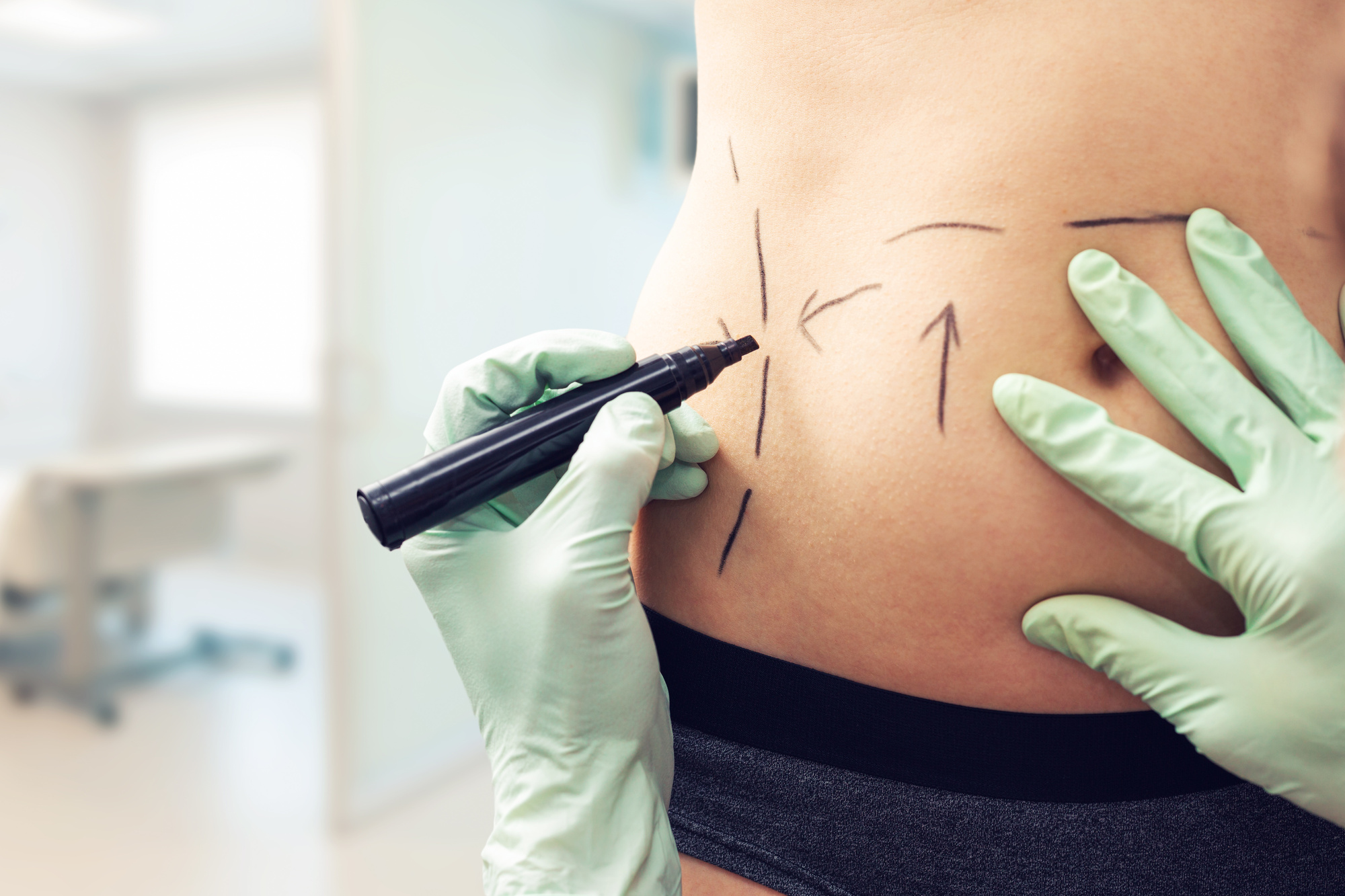 Confused if you need a tummy tuck or liposuction? Don't worry! We've got all the information you need to make the right decision here.